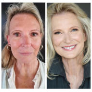 M Beauty by Dr. Tess - Photodynamic Therapy PDT for Acne